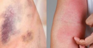 15 signs that indicate you may have leukemia, and that you should never ignore