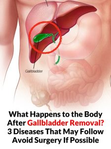 Gallbladder removal: what happens next and 3 risks to watch for