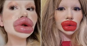 24-year-old woman wants the biggest lips in the world