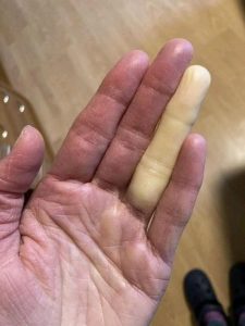 I followed a viral challenge and kept my hand in ice water to “boost circulation.” Ten minutes later, everything looked normal—except one finger, pale and numb like it didn’t belong to me. Anyone know