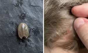 The Little Scalp Invader! What Parents Should Do When a Strange Bug Appears in Their Childs Hair!