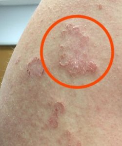 If You See Red Marks Appearing on Your Arm, Don’t Ignore Them