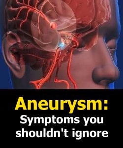 Aneurysm: Signs You Shouldn’t Ignore…