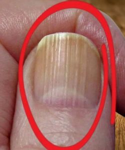 Having Striped Nails Could Mean That Your Body is!