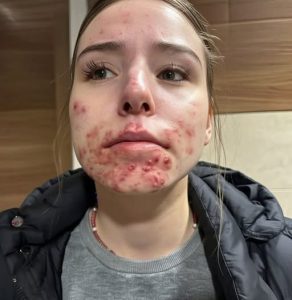 Still Breaking Out on Your Chin as an Adult Here’s What Could Be Causing It